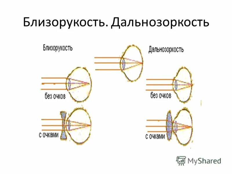 Глаз очки дальнозоркость и близорукость. Дальнозоркость. Близорукость. Очки для близорукости и дальнозоркости. Миопия и гиперметропия.