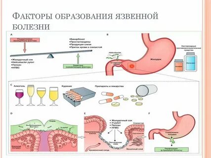 Профилактика гастрита и язвы желудка