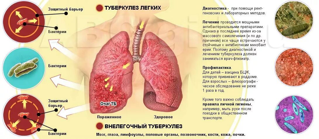 При туберкулезе чаще поражаются. Туберкулез бактериальное заболевание. Поражение органов при туберкулезе. Легкие пораженные туберкулезом. Легкие больного туберкулезом.