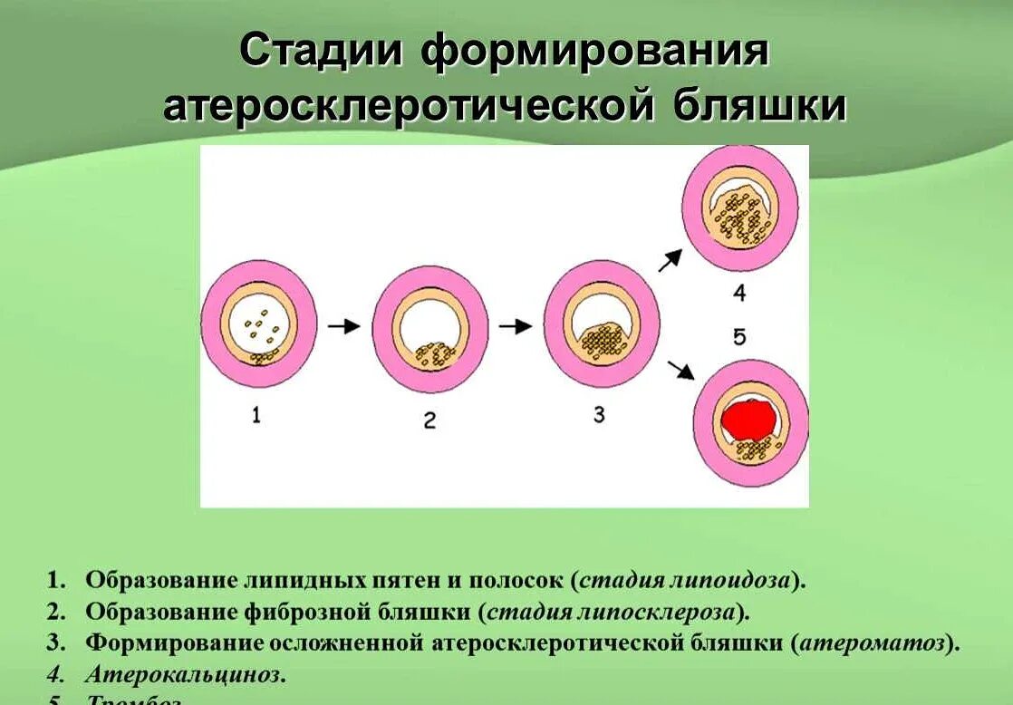 Стадии атеросклеротической бляшки. Этапы развития атеросклеротической бляшки. стадии образования атеросклеротической бляшки. схема развития атеросклеротической бляшки. атеросклероз стадия липидного пятна.