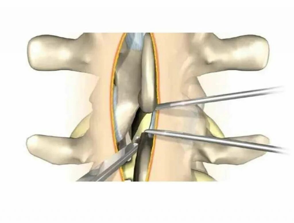 Ламинэктомия поясничного отдела. Ламинэктомия поясничного отдела позвоночника. Декомпрессионная ламинэктомия. Операция ламинэктомия. Операция на дисках позвоночника