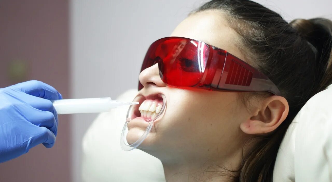 Отбеливание зубов. Косметическое отбеливание зубов. Отбеливание зубов в стоматологии. Методы отбеливания зубов в стоматологии.