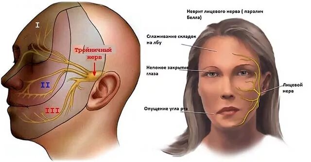 Воспаление тройничного лицевого нерва. Тройничный лицевой нерв.