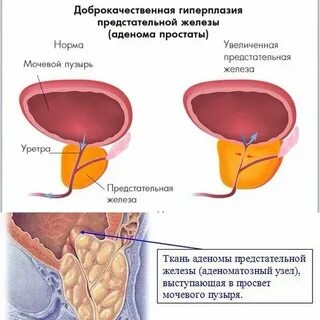 Предстательная железа что такое дгпж