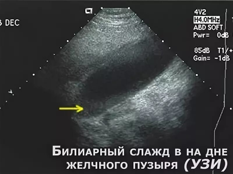 Вода для желчного пузыря. Билиарный сладж в желчном пузыре на УЗИ. Замазкообразная желчь в желчном пузыре на УЗИ. Эхограмма желчного пузыря. Взвесь в желчном пузыре на УЗИ.