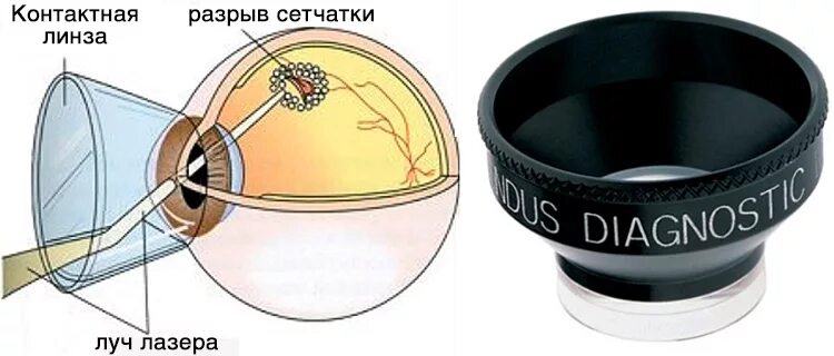Лазерное укрепление сетчатки. Отслоение сетчатки глазное дно. ограничительная лазеркоагуляция сетчатки глаза. линза для лазерной коагуляции сетчатки. фокальная лазерная коагуляция сетчатки глаза.
