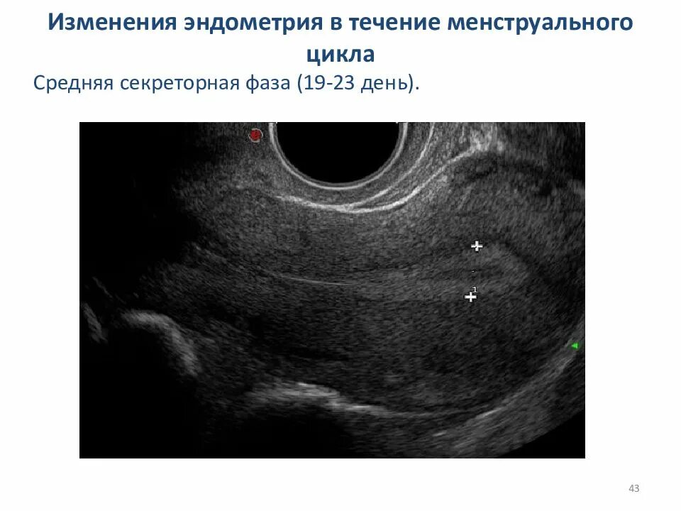 Изменение эндометрия матки. Эндометрия пролиферативная фаза УЗИ. Эндометрий по УЗИ по фазам цикла. Пролиферативный эндометрий УЗИ.