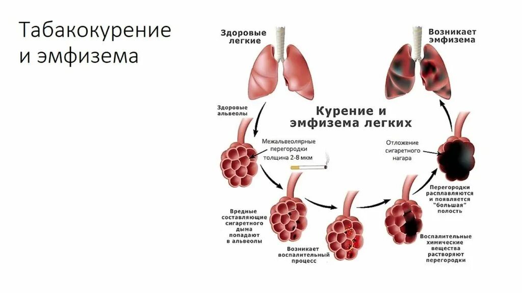 Эмфизематозная перестройка легочной ткани что такое. Увеличенные легкие причины. Осложнения буллезной эмфиземы. Эмфизематозность легких. Эмфизема легких патологические изменения.