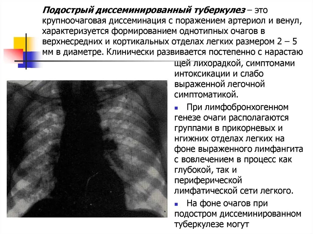 Диссеминированный туберкулез легких фазы. Диссеминированный туберкулез в фазе инфильтрации. Рентгенологические симптомы диссеминированного туберкулеза. Подострый диссеминированный туберкулез. Острый диссеминированный туберкулез рентген.