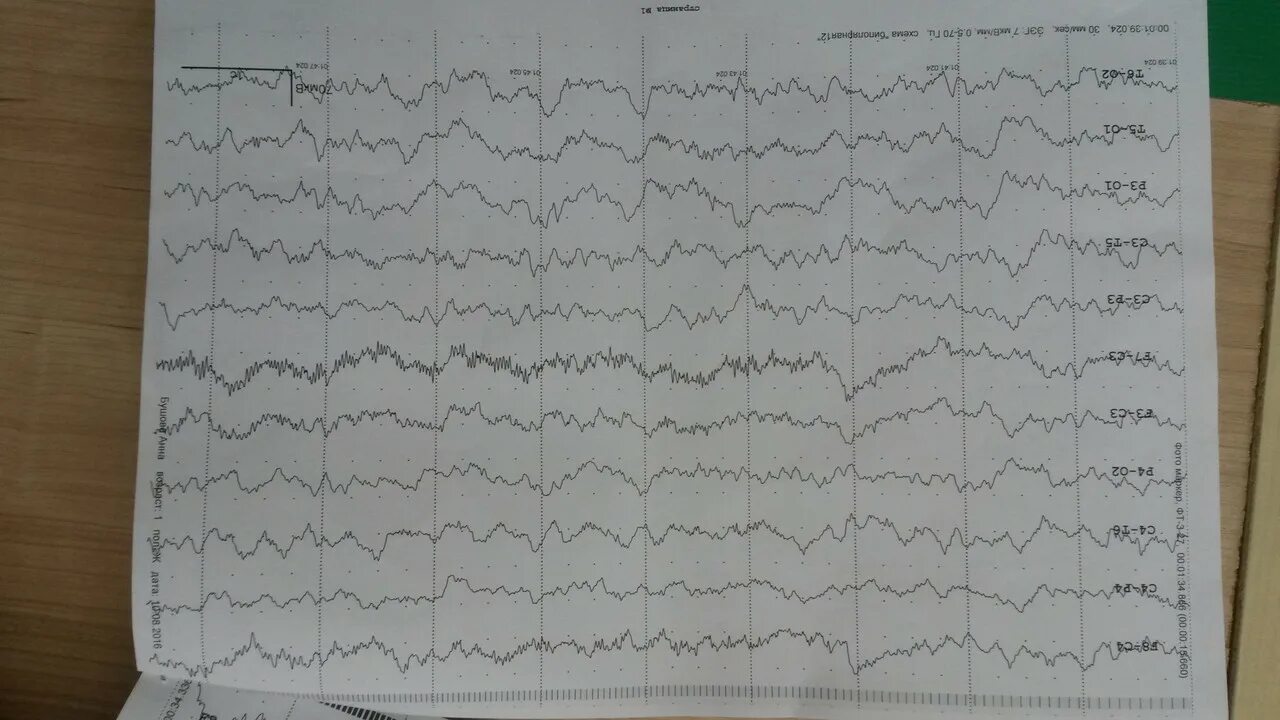 Ээг новокузнецк. Эпилептиформная активность на ЭЭГ. ЭЭГ при энцефалите. ЭЭГ при герпетическом энцефалите. Эпилептиформная активность на ЭЭГ назначения невролога.