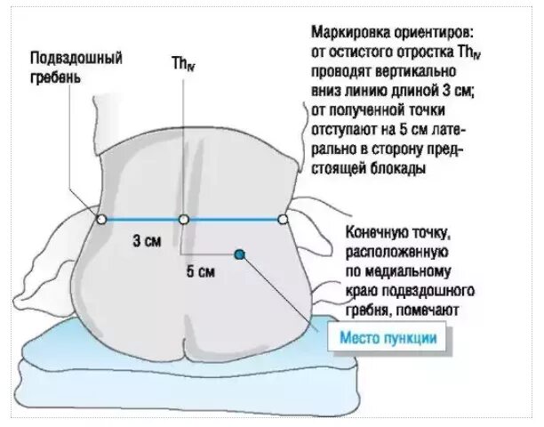 Как действует блокада. Техника выполнения блокады поясничного отдела. Техника проведения блокады поясничного отдела позвоночника. Блокада пояснично-крестцового отдела схема. Блокада корешкового синдрома поясничного отдела.