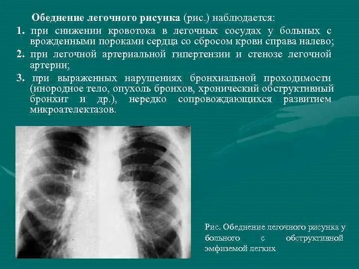 Легочной рисунок на рентгенограмме. Заболевания легких на рентгене. Легочный рисунок обеднен. Обеднение легочного рисунка.