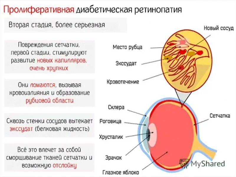 Ангиопатия сетчатки мкб 10