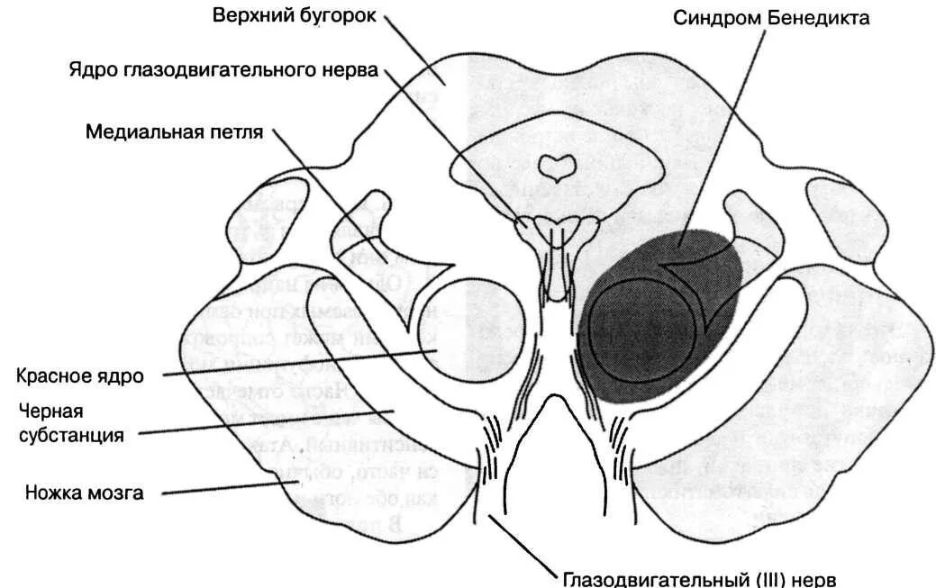 Стационарное ядро. Красное ядро среднего мозга. Красное ядро среднего мозга схема. Альтернирующие синдромы среднего мозга. Поражение ядер среднего мозга.