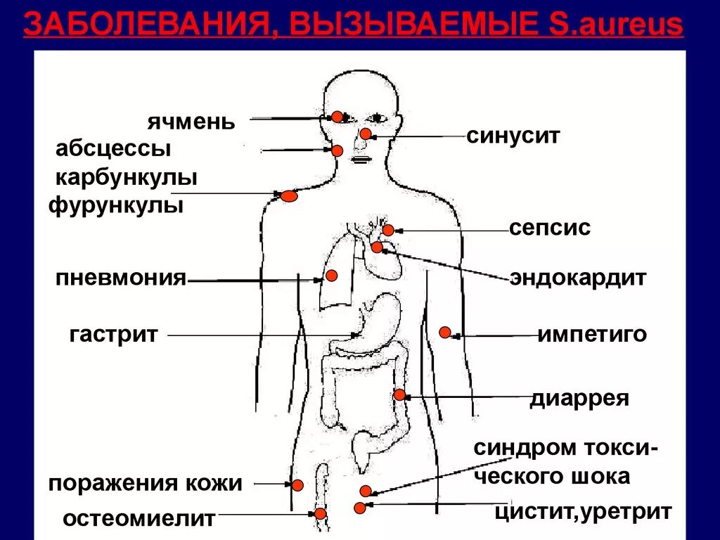 Какое заболевание вызывает стафилококк. Заболевания человека вызываемые стафилококками. Симптомы стафилококковой инфекции. Инфекции вызванные стафилококком. S aureus вызывает заболевания.