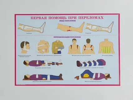 Виды переломов оказание первой помощи при переломах