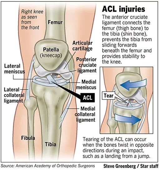 Acl что это. ACL колено связки коленного. Крестообразная мышца в колене.