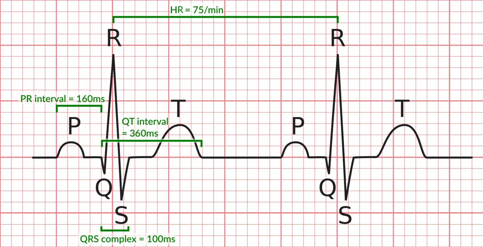 Расширение QRS на ЭКГ. Удлинение комплекса QRS. Комплекс PQRST. ЭКГ PQRST.