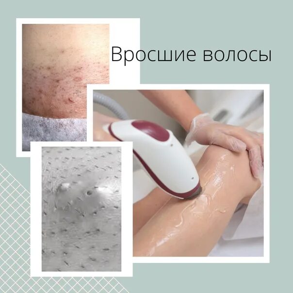 На лобке вросшие волосы: Как избавиться от вросших волос