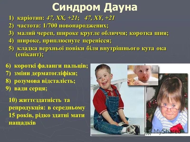 Синдром дауна интеллект. Синдром дауна частота. синдром дауна презентация. синдром дауна история.