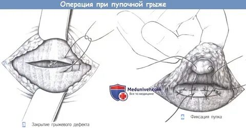 Сеточка пупочной грыжи