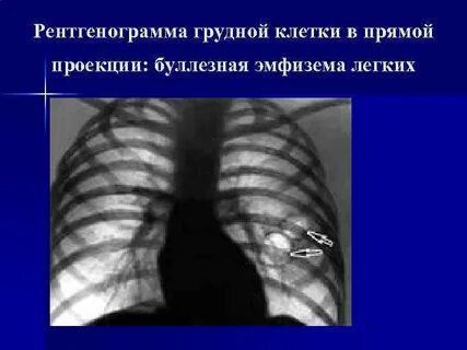 Грудная эмфизема