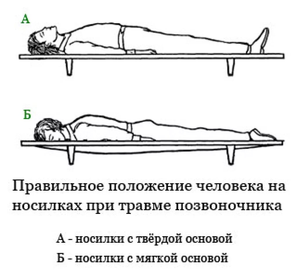 Повреждение позвоночника необходимо. Перемещение пострадавшего с травмой позвоночника. Транспортировка пострадавшего при повреждении позвоночника. Положение пациента с переломом позвоночника при транспортировке:. Транспортировка при переломе позвон.