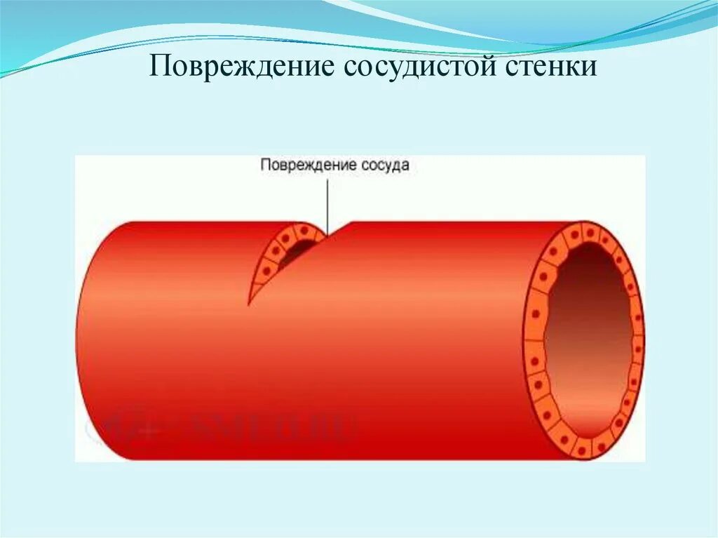 Разрыв кровеносного сосуда. Повреждение сосудистой стенки. Фактор повреждения сосудистой стенки. Субэндотелиальный слой аорты. Субэндотелиальные соединительнотканные структуры.