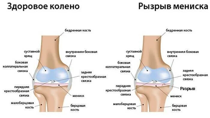 Болит ли мениск. Строение колена-мениск анатомия. Мениски коленного сустава анатомия. Повреждение мениска коленного сустава. Внешние симптомы повреждения мениска коленного сустава.