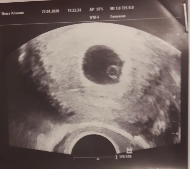 Узи 5 недель не видно эмбриона