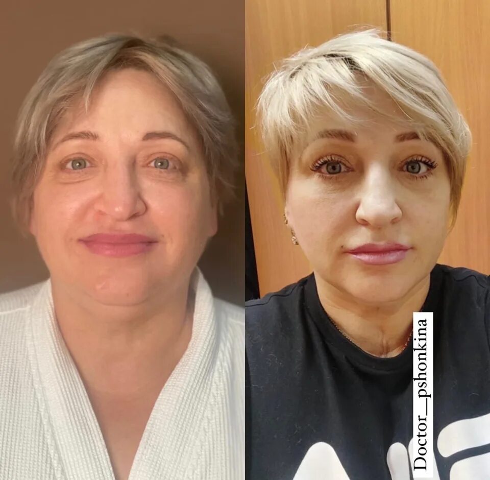 Коррекция мимических морщин. Омолаживающие операции лица. Омолаживающие операции лица. Холодная пластика лица. Омолаживающая пластика южная корея.