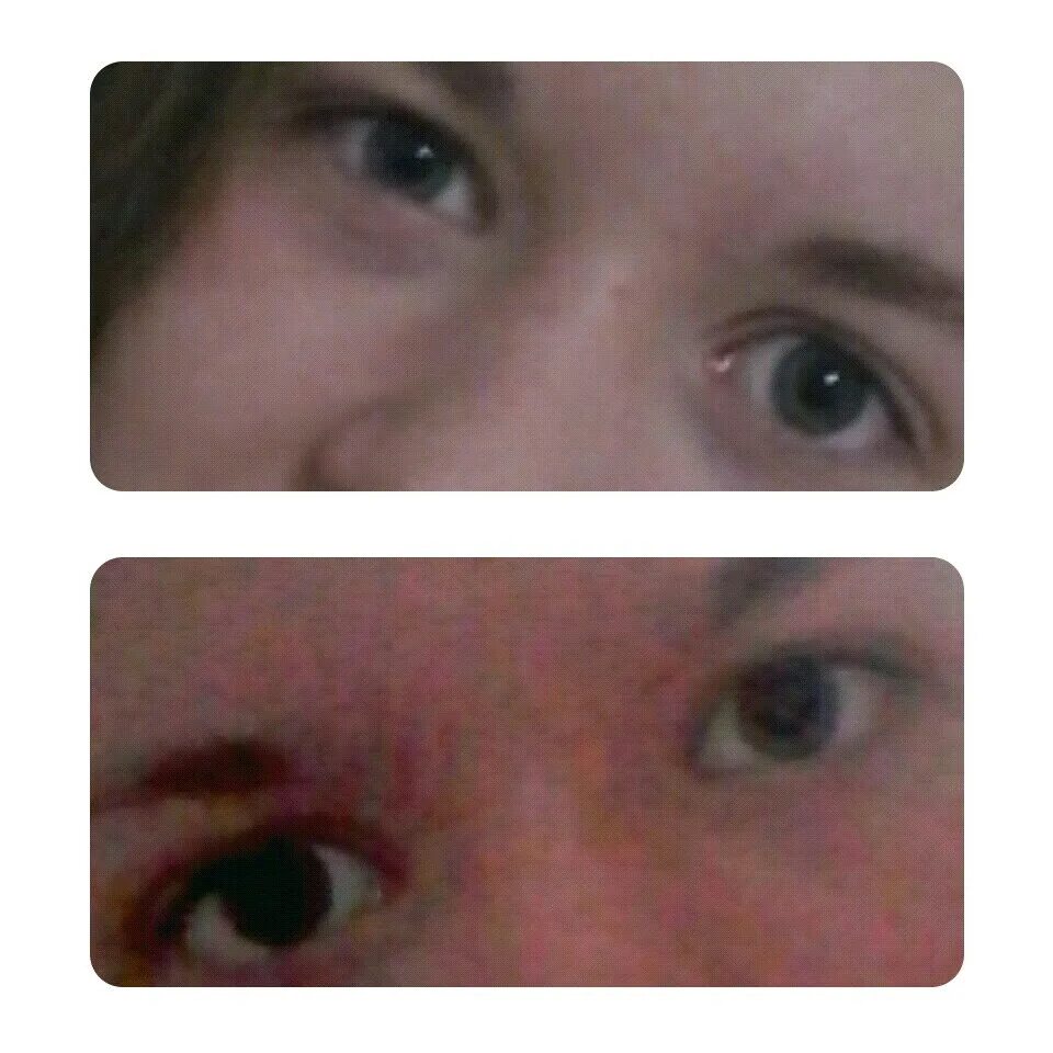 Один глаз большой другой маленький. Один глаз больше другого. Асимметрия глазных щелей. Один глаз меньше другого.