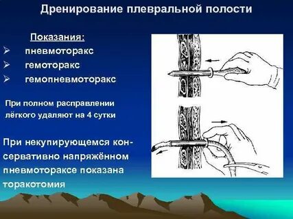 Уход при пневмотораксе