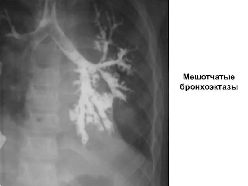 Болезни легких у детей. Цилиндрические и мешотчатые бронхоэктазы. Цилиндрические бронхоэктазы. Мешочковые бронхоэктазы. Бронхография цилиндрические бронхоэктазы.