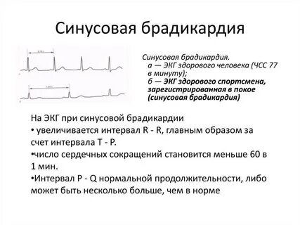 Синусовый ритм вертикальное положение электрической оси сердца