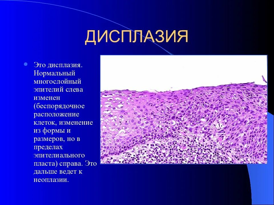 Гиперплазия метаплазия дисплазия. Метаплазия желудка гистология. Чем отличается дисплазия от гиперплазии. Пищевод баретагистология. Пизевод баррета патанатомия.