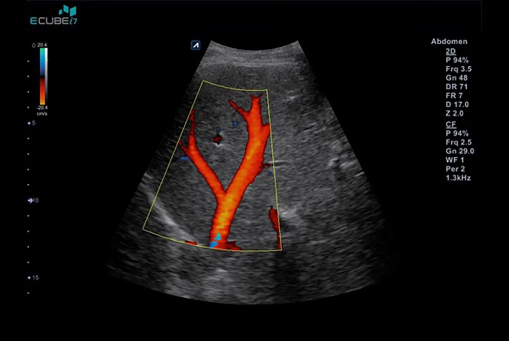 Доплер конечностей. Допплер гломерулонефрит Ольхова. Bf5000 допплер. Renal artery Doppler. Гидравлической платформы Doppler (Тип os/804/t) фото.