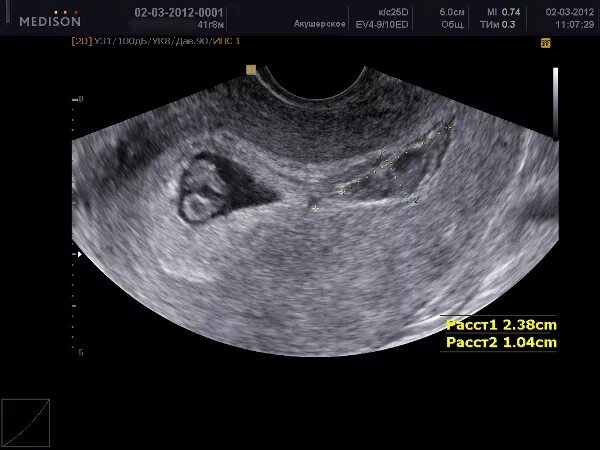 Матка 6 7 недель. Ретрохориальная гематома на УЗИ. Гематома на матке при беременности УЗИ. Гематома в матке на ранних сроках. Ретрохориальная гемангиома.