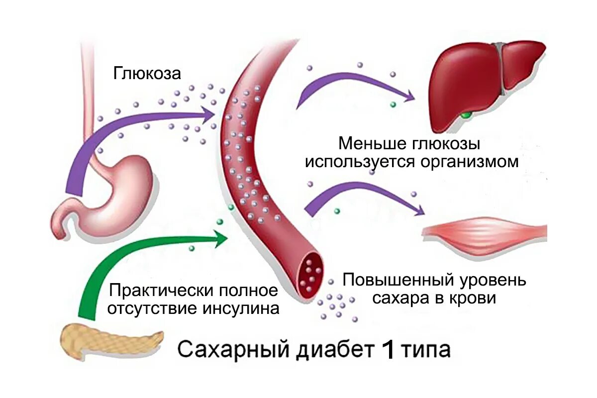 Сахарный диабет 1 типа инсулинозависимый. Инсулинзависимый сахарный диабет типа i. Сахарный диабет 2 типа. Типы сахарного диабета 1 типа.