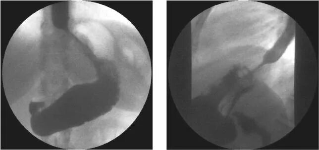 Кардиальный жом желудка. Кардия смыкается не полностью. Недостаточность гардин. Кардия желудка что это такое анатомия. Кардия смыкается не полностью.