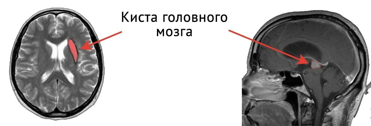 Киста головного мозга последствия. Постгеморрагическая киста головного мозга. Ретроцеребеллярная киста. Субэпендимальная киста головного мозга. Гидроцефалия и киста головного мозга у ребенка.