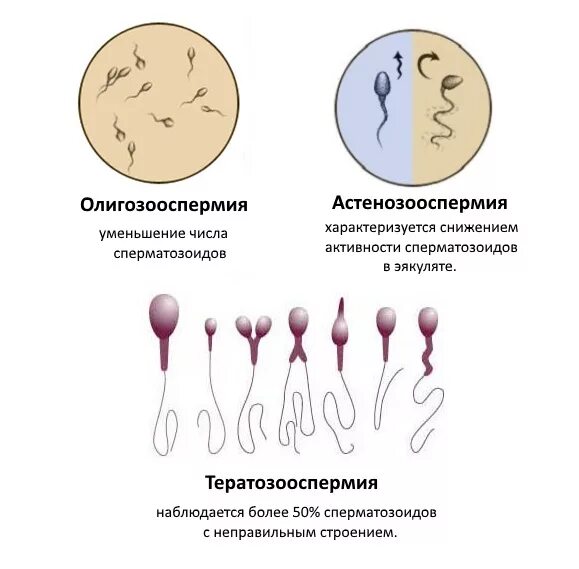 Женские спермии. Спермограмма заключение тератозооспермия вискозипатия. Спермограмма подвижность сперматозоидов. Спермограмма олигозооспермия. Тератозооспермия патологии сперматозоидов.