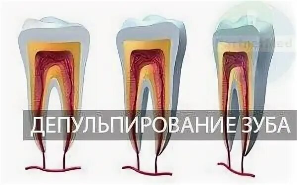 Что такое депульпирование зуба перед протезированием. Депульпация корня зуба. депульпирование зуба перед. депульпирование зуба центродент. протезирование депульпированного зуба.