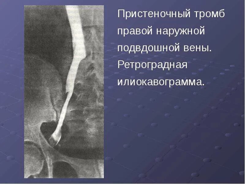 Подкожная вена нижней конечности анатомия. Ретроградная вена. Малоберцовая вена анатомия. Перевязка несостоятельных перфорантных вен. Pegmatite vein.