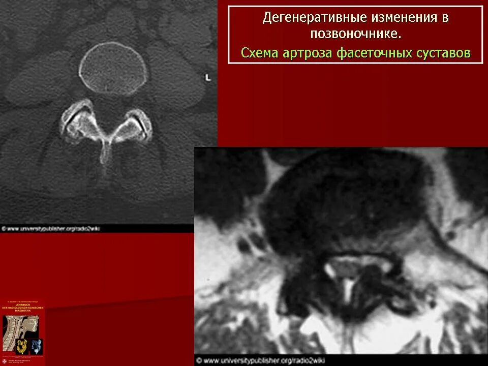 Дегенеративные поражения позвоночника. Дегенеративные изменения позвоночника. Дегенеративно-дистрофические изменения позвоночника статистика. Хирургия дегенеративных поражений позвоночника книга.