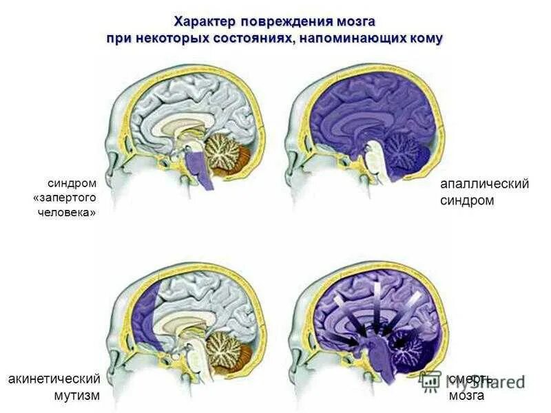 Причины повреждение мозга. Апаллический синдром. Синдром запертого человека. Апаллический синдром бодрствующая кома. Апаллический синдром и вегетативное состояние.