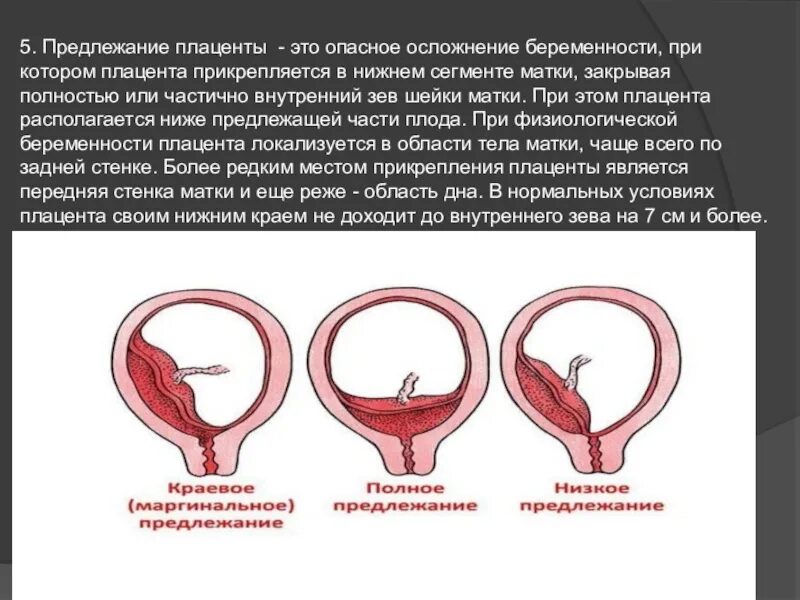 Классификация предлежания плаценты, краевое. Центральное боковое и краевое предлежание плаценты. Внутреннего зева при беременности. Предлежание плаценты внутренний зев.