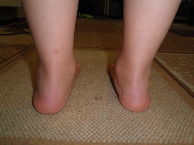 Плоскостопие вальгусная нога. Плоскостопие вальгусная стопа. Плосковальгусная стопа у детей. Плано-вальгвсные стопы.