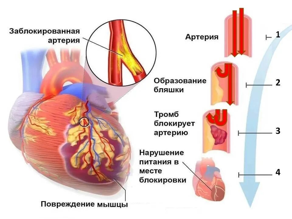 Причины развития острого инфаркта миокарда. Острый период инфаркта миокарда клиника. Бляшки инфаркт миокарда. Сердце при инфаркте миокарда. Симптомы микроинфаркта у женщин