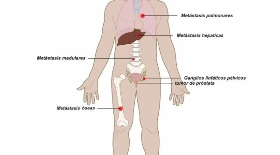 Метастазы в печени 4 стадия сколько живут. Органы мишени метастазов.